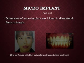 MICRO IMPLANTMICRO IMPLANT
• Dimension of micro implant are 1.2mm in diameter &Dimension of micro implant are 1.2mm in diameter &
6mm in length.6mm in length.
-Park et al
28yr old female with CL-I bialveolar protrusion before treatment.
 