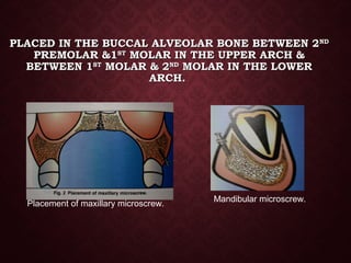 PLACED IN THE BUCCAL ALVEOLAR BONE BETWEEN 2PLACED IN THE BUCCAL ALVEOLAR BONE BETWEEN 2NDND
PREMOLAR &1PREMOLAR &1STST
MOLAR IN THE UPPER ARCH &MOLAR IN THE UPPER ARCH &
BETWEEN 1BETWEEN 1STST
MOLAR & 2MOLAR & 2NDND
MOLAR IN THE LOWERMOLAR IN THE LOWER
ARCH.ARCH.
Placement of maxillary microscrew.
Mandibular microscrew.
 