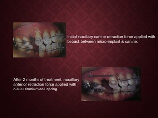 Initial maxillary canine retraction force applied with
tieback between micro-implant & canine.
After 2 months of treatment, maxillary
anterior retraction force applied with
nickel titanium coil spring.
 