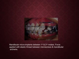 Mandibular micro-implants between 1st
& 2nd
molars. Force
applied with elastic thread between microscrews & mandibular
archwire.
 