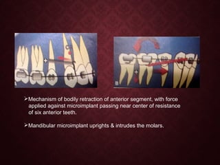 Mechanism of bodily retraction of anterior segment, with force
applied against microimplant passing near center of resistance
of six anterior teeth.
Mandibular microimplant uprights & intrudes the molars.
 