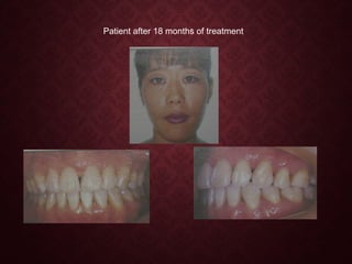 Patient after 18 months of treatment
.
 