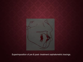Superimposition of pre & post- treatment cephalometric tracings.
 