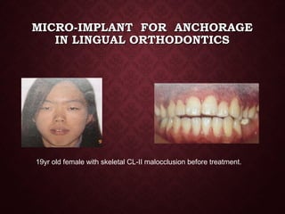 MICRO-IMPLANT FOR ANCHORAGEMICRO-IMPLANT FOR ANCHORAGE
IN LINGUAL ORTHODONTICSIN LINGUAL ORTHODONTICS
19yr old female with skeletal CL-II malocclusion before treatment.
 