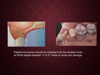 Palatal microscrew should be implanted into the alveolar bone
at 30-40 degree between 1st
& 2nd
molar to avoid root damage.
 