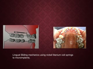 Lingual Sliding mechanics using nickel titanium coil springs
to microimplants.
 