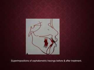 Superimpositions of cephalometric tracings before & after treatment.
 