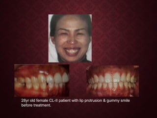 28yr old female CL-II patient with lip protrusion & gummy smile
before treatment.
 