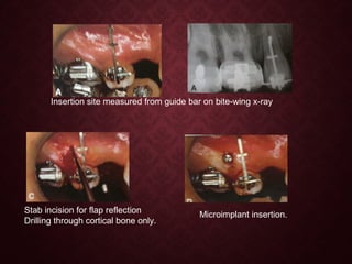 Insertion site measured from guide bar on bite-wing x-ray
Stab incision for flap reflection
Drilling through cortical bone only.
Microimplant insertion.
 