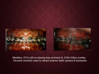 Maxillary .017x.o25 ss closing loop archwire & .016x.016ss overlay
intrusion archwire used to retract anterior teeth upward & backward.
 