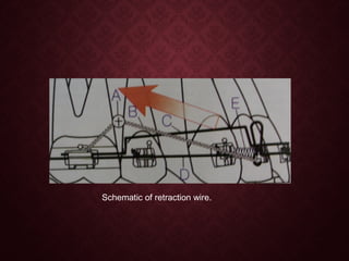 Schematic of retraction wire.
 