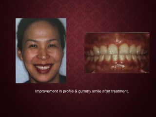 Improvement in profile & gummy smile after treatment.
 