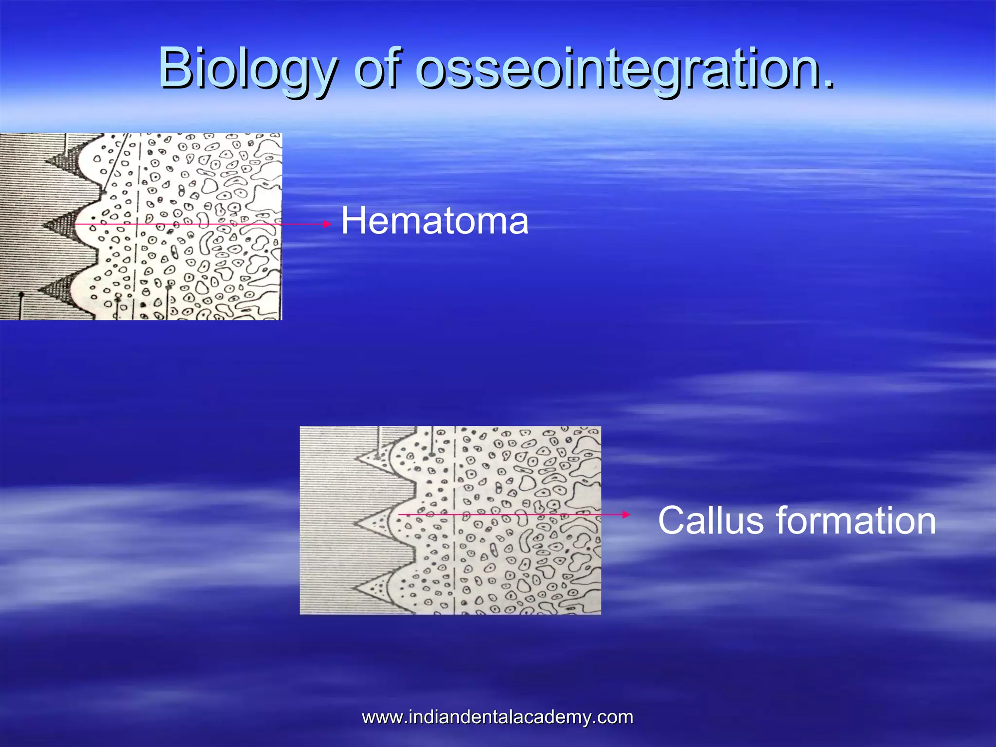 Biology of osseointegration.
Hematoma

Callus formation

www.indiandentalacademy.com

 