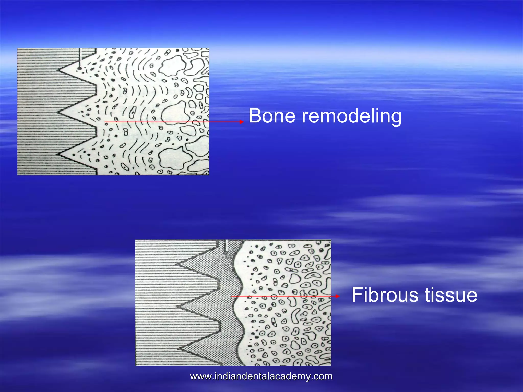 Bone remodeling

Fibrous tissue

www.indiandentalacademy.com

 