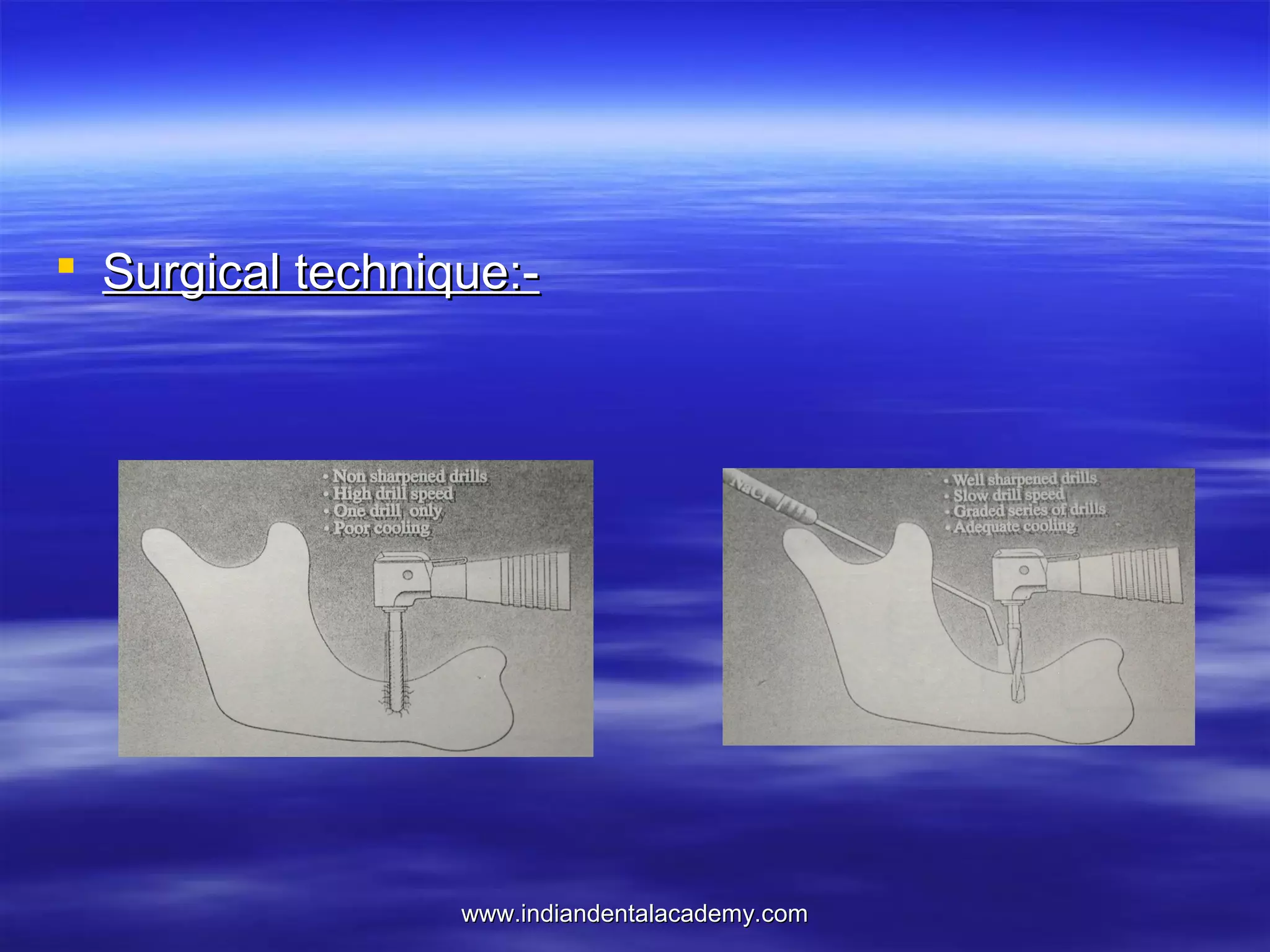  Surgical technique:-

www.indiandentalacademy.com

 