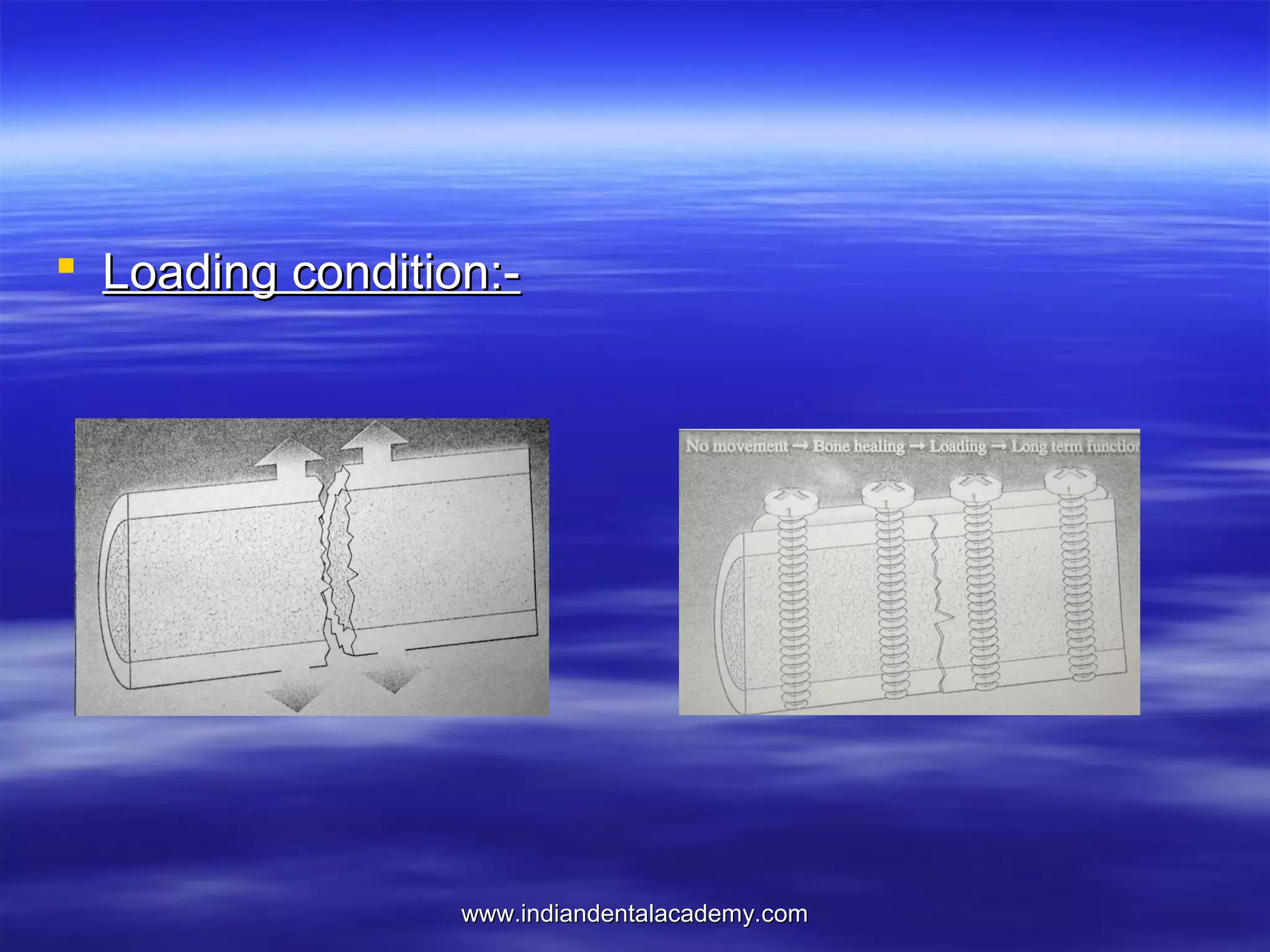  Loading condition:-

www.indiandentalacademy.com

 