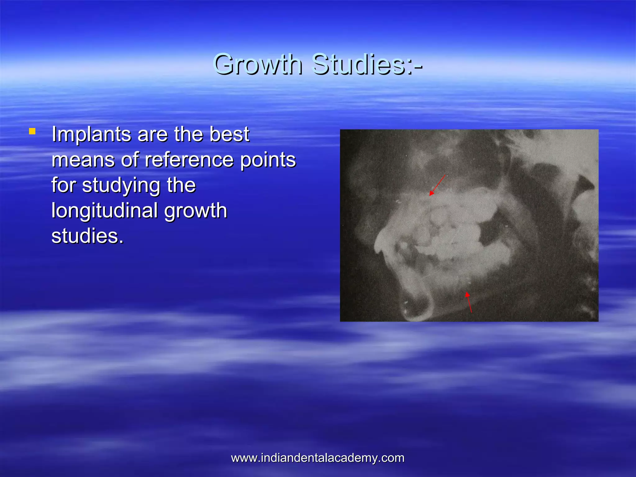 Growth Studies: Implants are the best
means of reference points
for studying the
longitudinal growth
studies.

www.indiandentalacademy.com

 