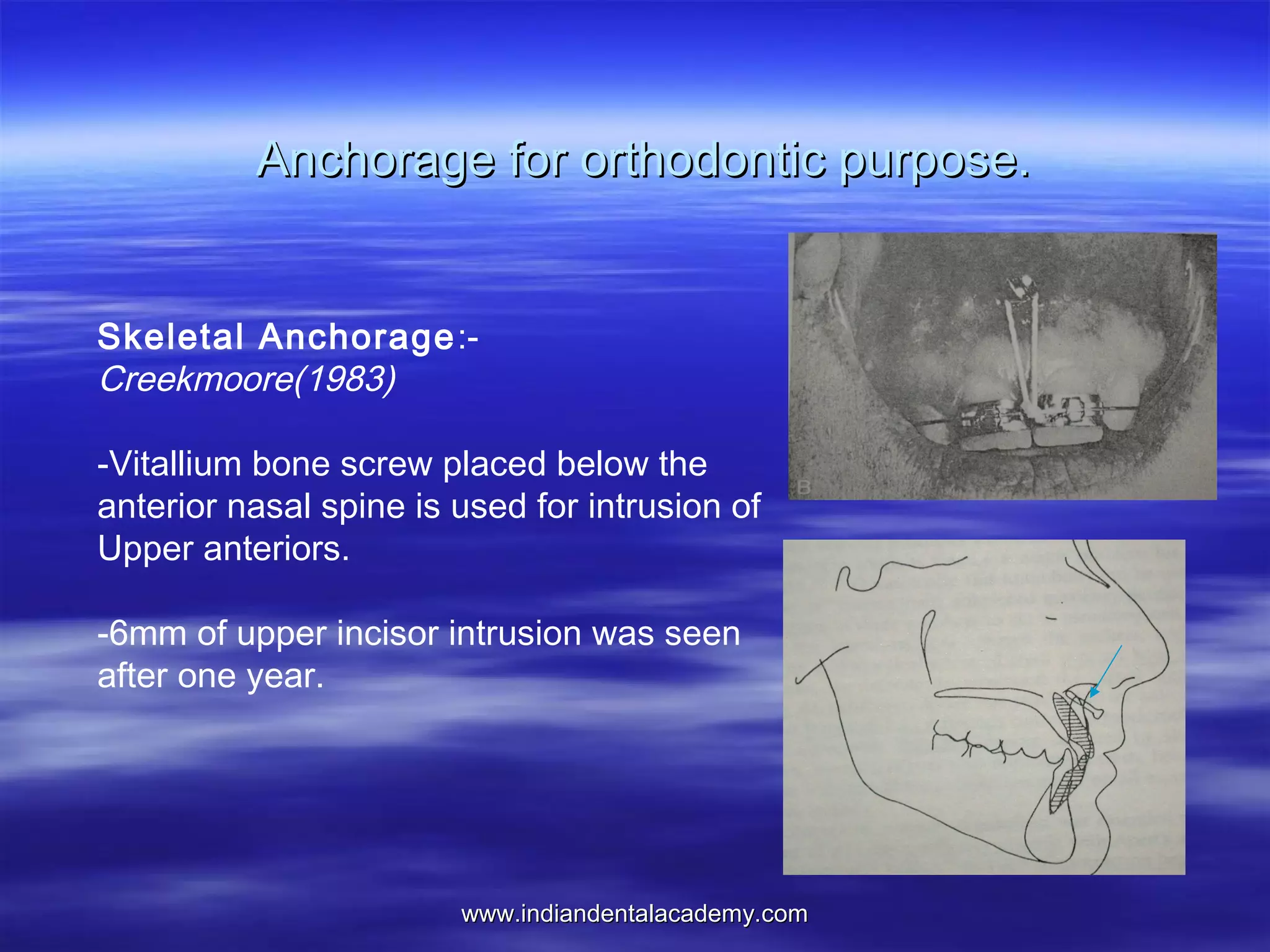 Anchorage for orthodontic purpose.
Skeletal Anchorage :Creekmoore(1983)
-Vitallium bone screw placed below the
anterior nasal spine is used for intrusion of
Upper anteriors.
-6mm of upper incisor intrusion was seen
after one year.

www.indiandentalacademy.com

 