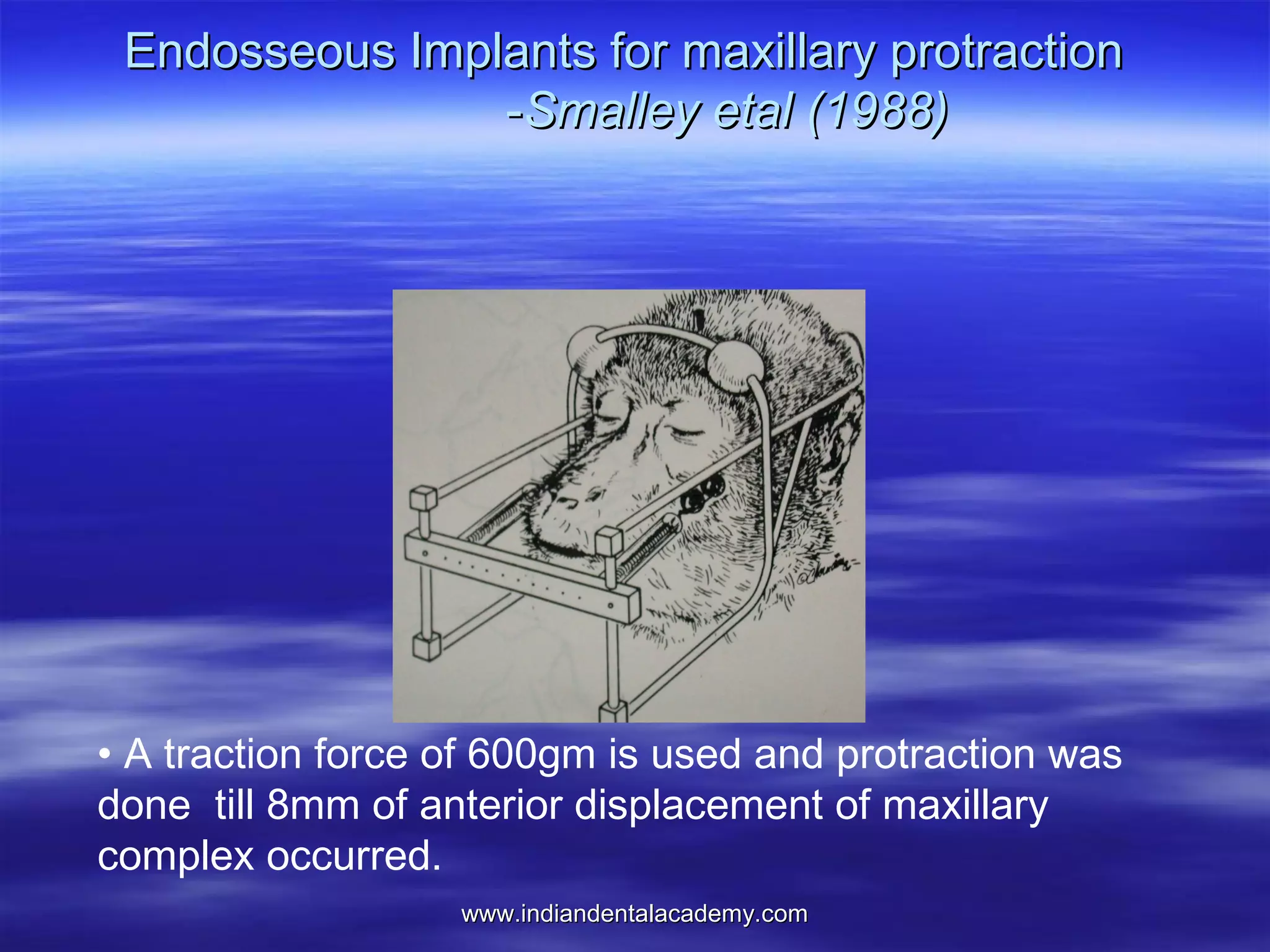 Endosseous Implants for maxillary protraction
-Smalley etal (1988)

• A traction force of 600gm is used and protraction was
done till 8mm of anterior displacement of maxillary
complex occurred.
www.indiandentalacademy.com

 