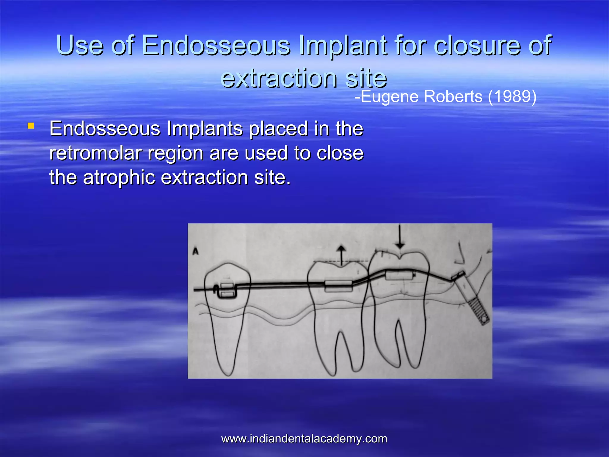 Use of Endosseous Implant for closure of
extraction site
-Eugene Roberts (1989)

 Endosseous Implants placed in the
retromolar region are used to close
the atrophic extraction site.

www.indiandentalacademy.com

 