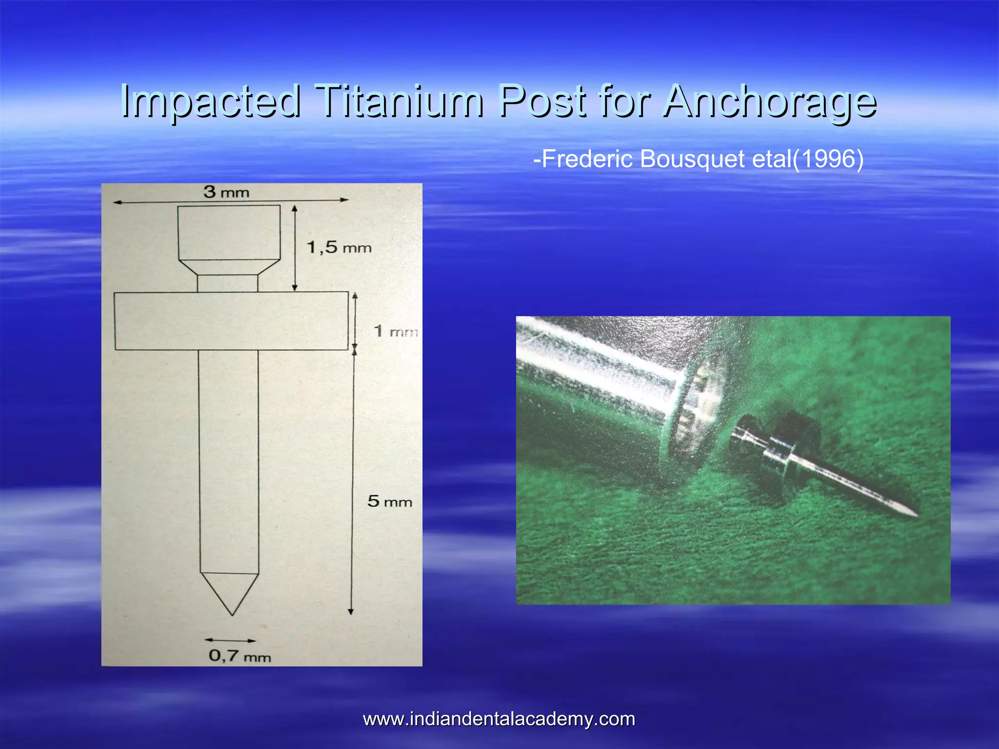 Impacted Titanium Post for Anchorage
-Frederic Bousquet etal(1996)

www.indiandentalacademy.com

 