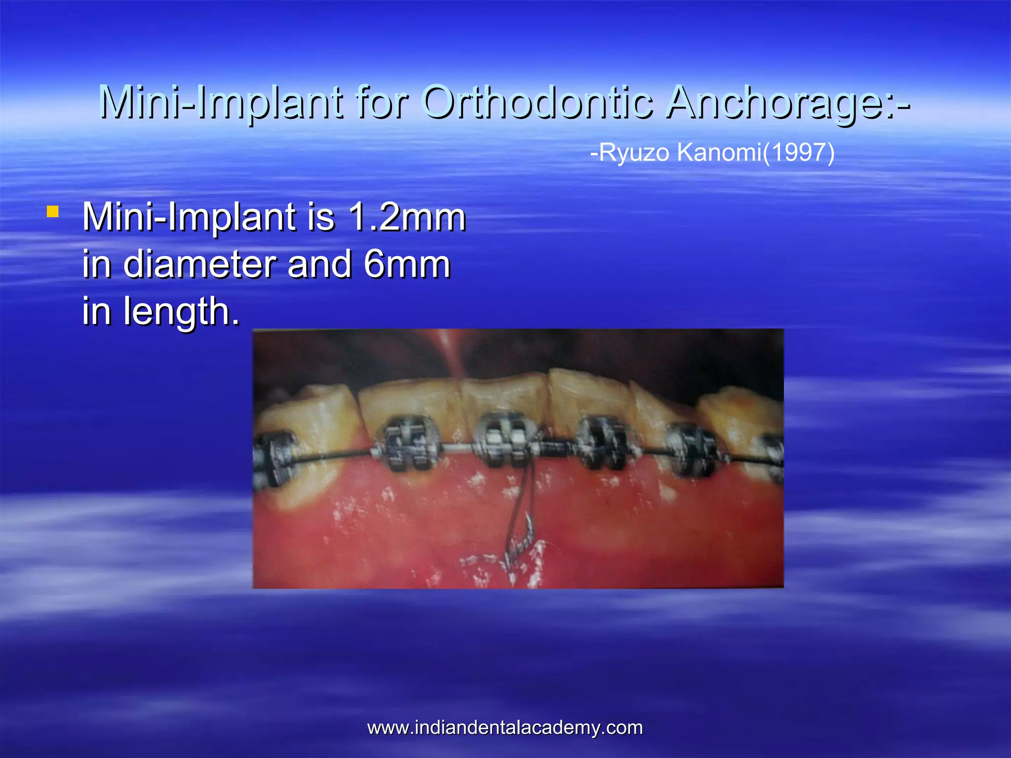 Mini-Implant for Orthodontic Anchorage:-Ryuzo Kanomi(1997)

 Mini-Implant is 1.2mm
in diameter and 6mm
in length.

www.indiandentalacademy.com

 