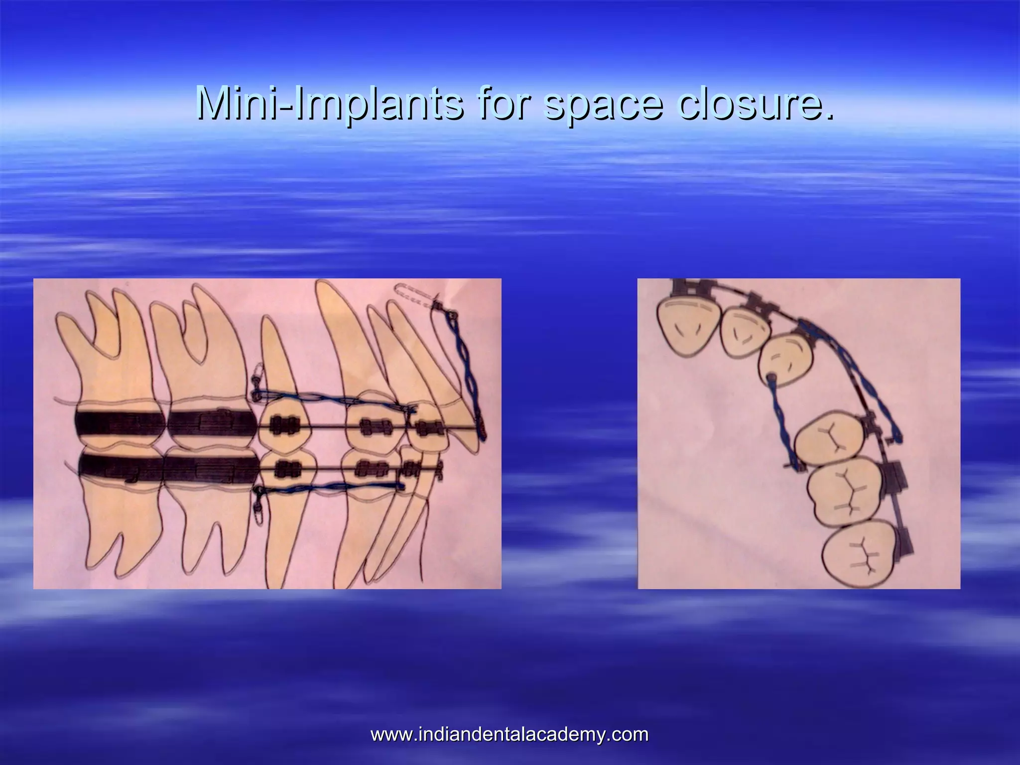 Mini-Implants for space closure.

www.indiandentalacademy.com

 