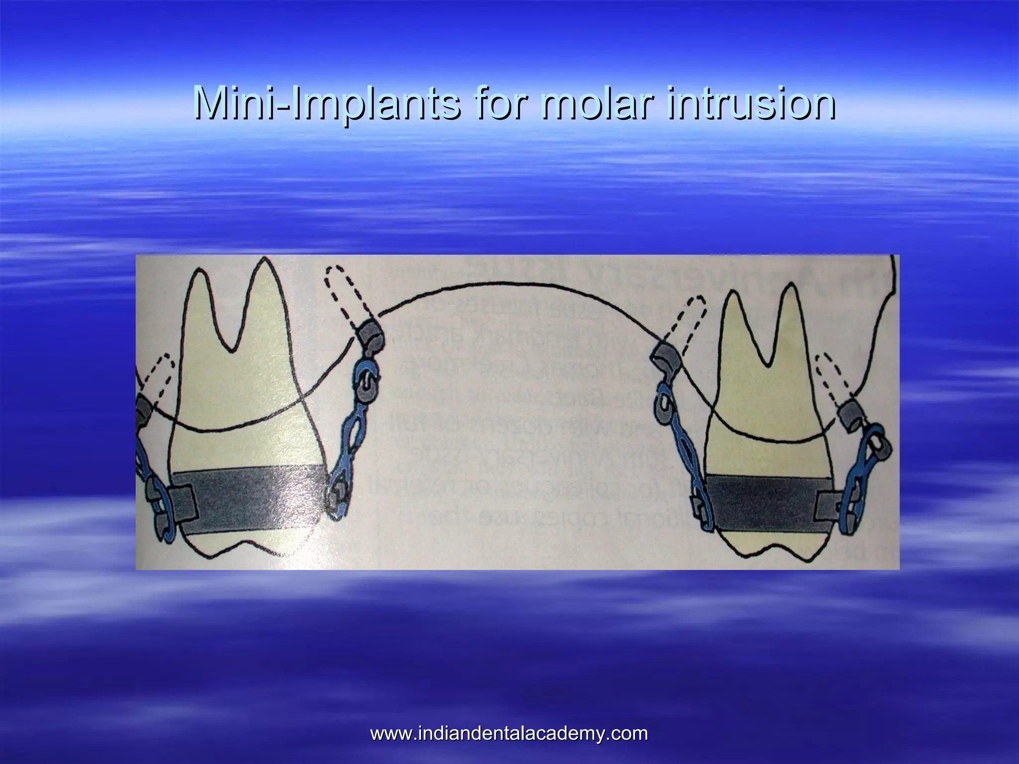 Mini-Implants for molar intrusion

www.indiandentalacademy.com

 