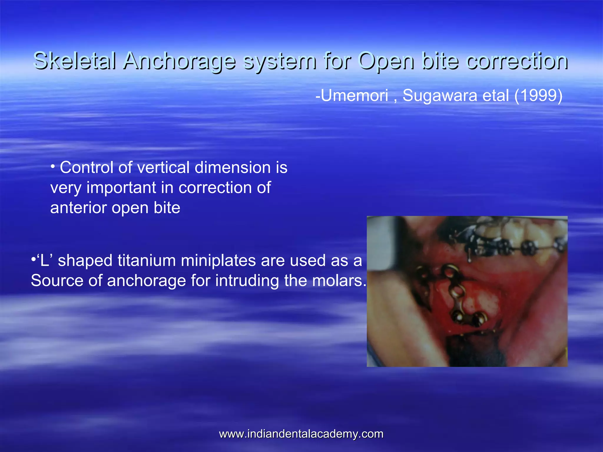 Skeletal Anchorage system for Open bite correction
-Umemori , Sugawara etal (1999)

• Control of vertical dimension is

very important in correction of
anterior open bite
•‘L’ shaped titanium miniplates are used as a
Source of anchorage for intruding the molars.

www.indiandentalacademy.com

 