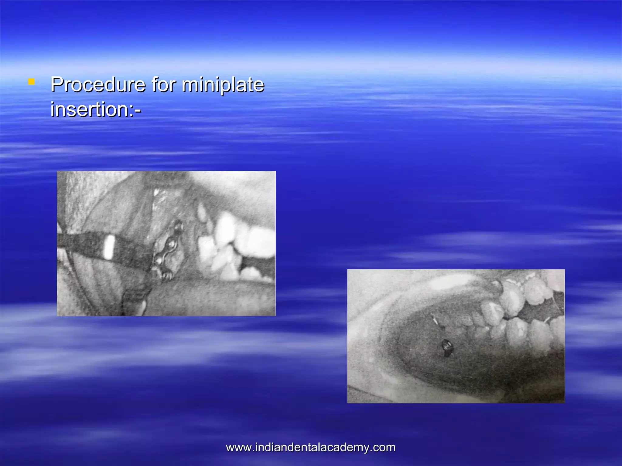  Procedure for miniplate
insertion:-

www.indiandentalacademy.com

 