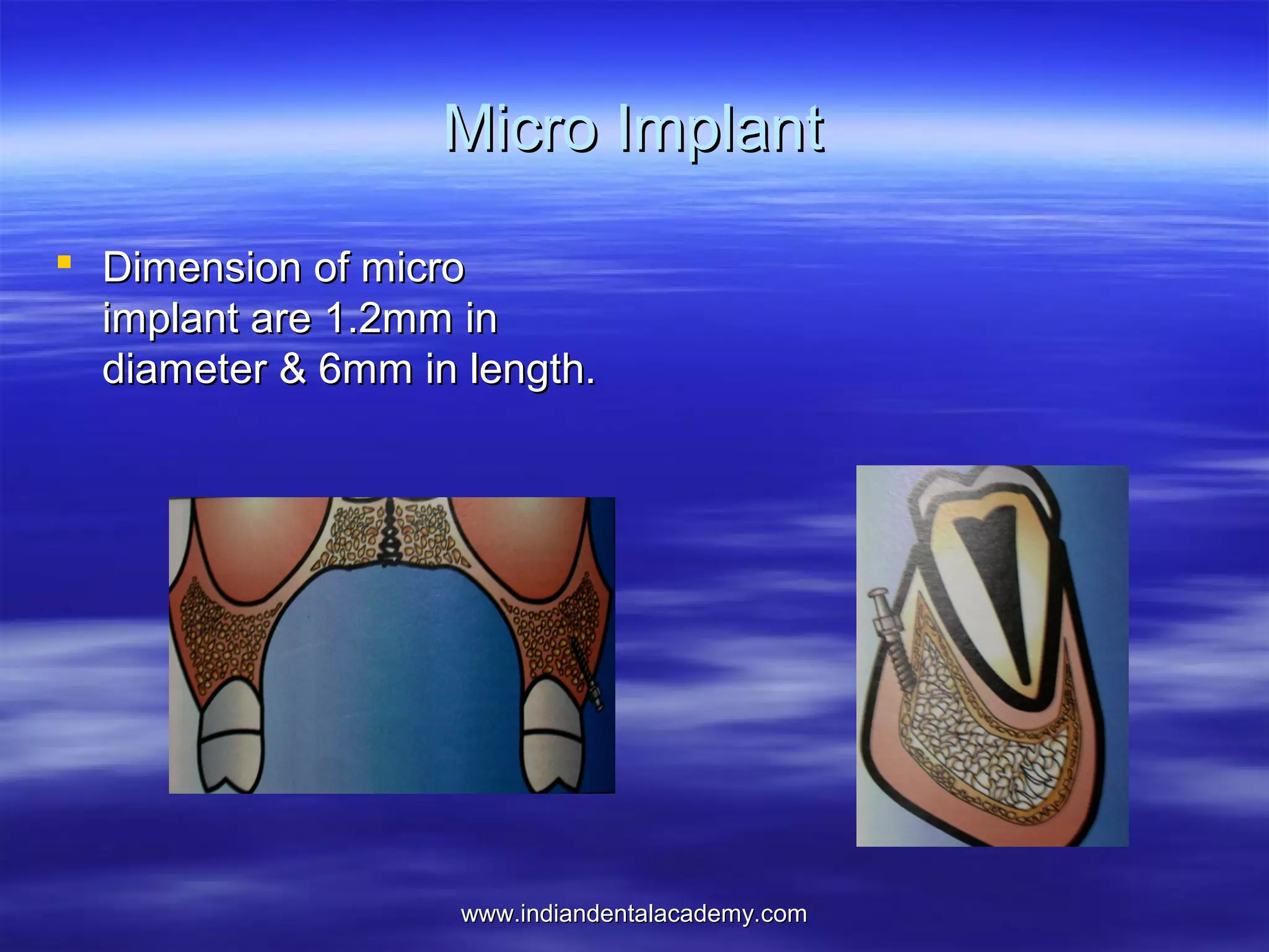 Micro Implant
 Dimension of micro
implant are 1.2mm in
diameter & 6mm in length.

www.indiandentalacademy.com

 