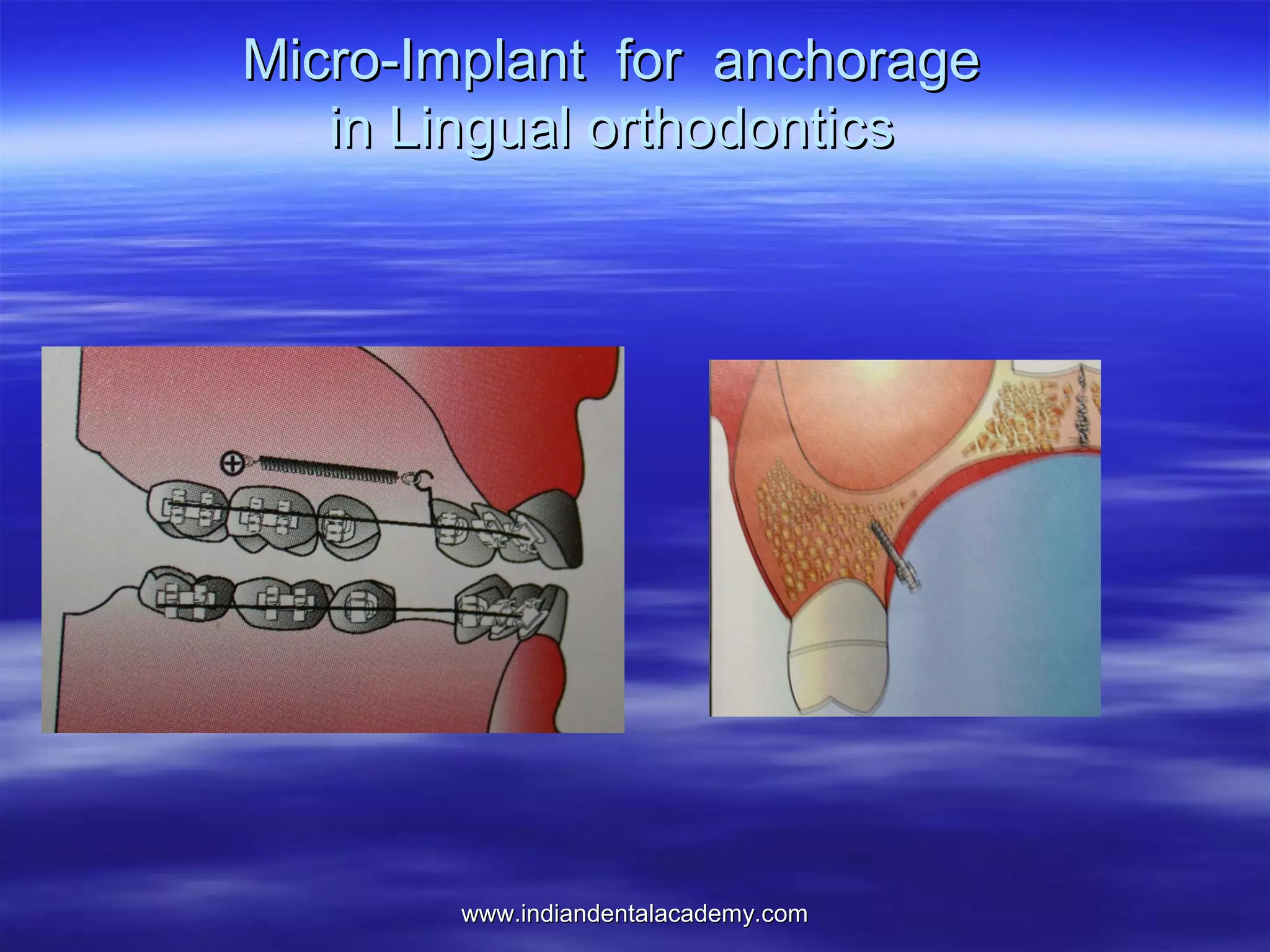 Micro-Implant for anchorage
in Lingual orthodontics

www.indiandentalacademy.com

 