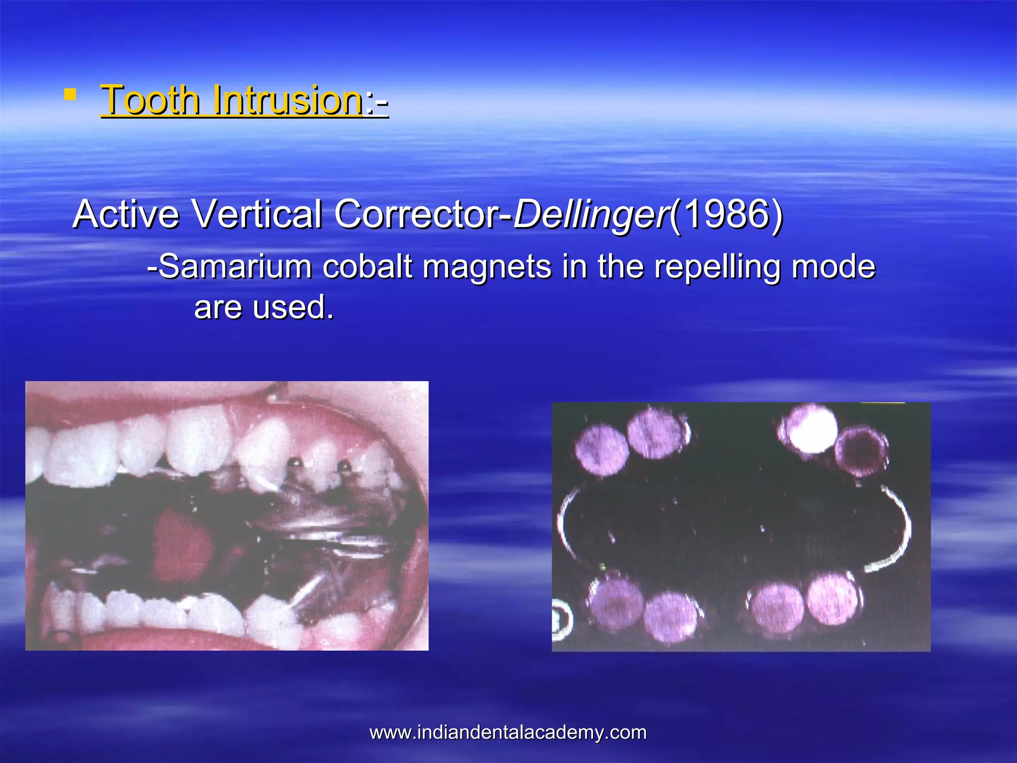  Tooth Intrusion:Active Vertical Corrector-Dellinger(1986)
-Samarium cobalt magnets in the repelling mode
are used.

www.indiandentalacademy.com

 