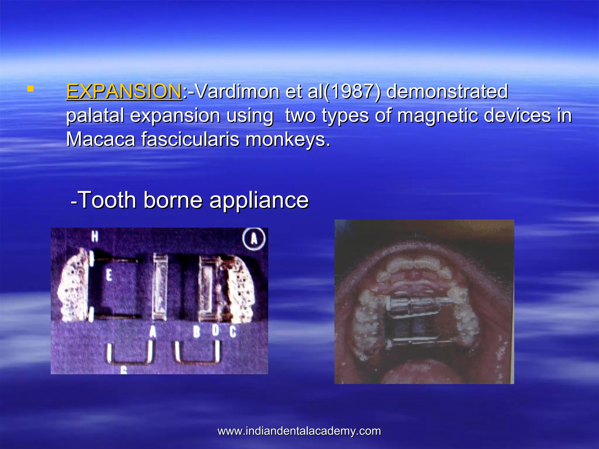 

EXPANSION:-Vardimon et al(1987) demonstrated
palatal expansion using two types of magnetic devices in
Macaca fascicularis monkeys.
-Tooth borne appliance

www.indiandentalacademy.com

 