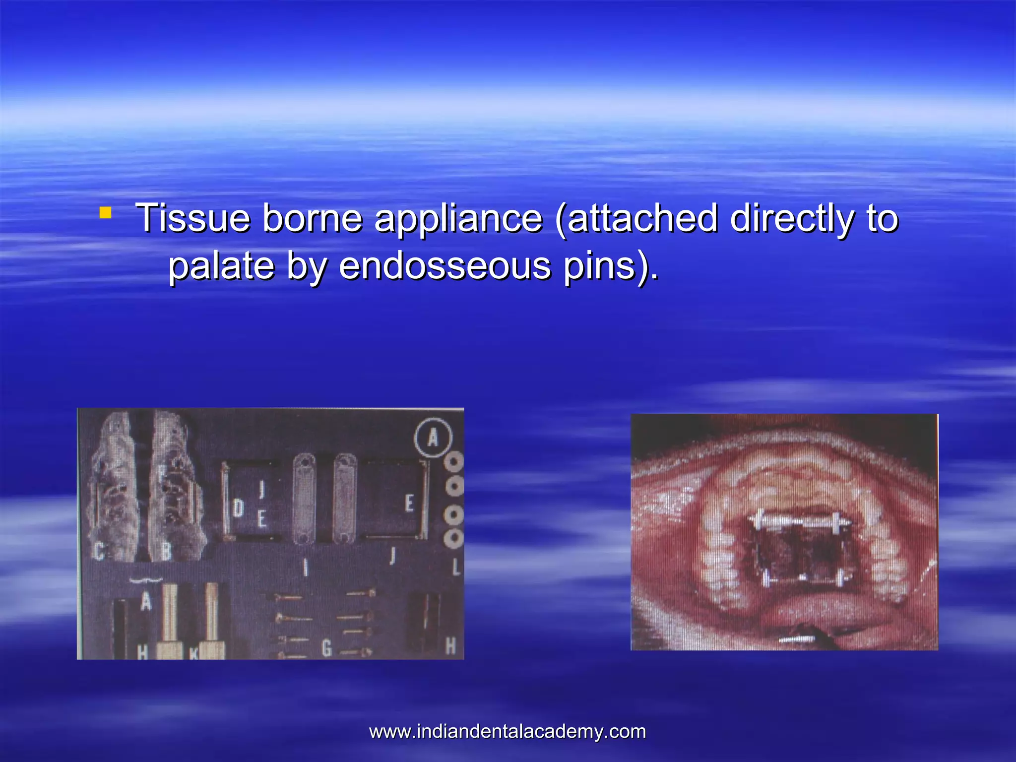  Tissue borne appliance (attached directly to
palate by endosseous pins).

www.indiandentalacademy.com

 