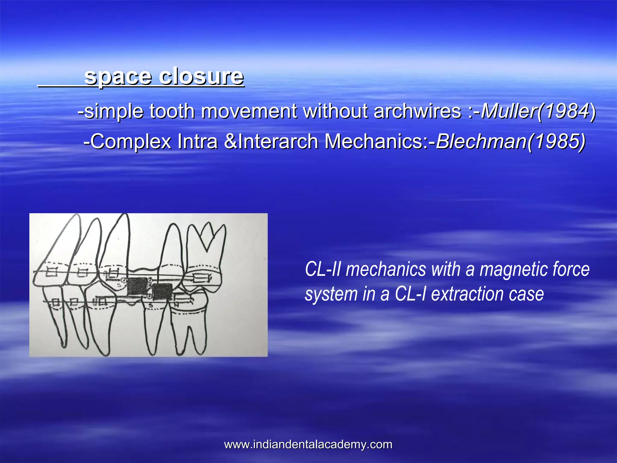 space closure
-simple tooth movement without archwires :-Muller(1984)
-Complex Intra &Interarch Mechanics:-Blechman(1985)

CL-II mechanics with a magnetic force
system in a CL-I extraction case

www.indiandentalacademy.com

 