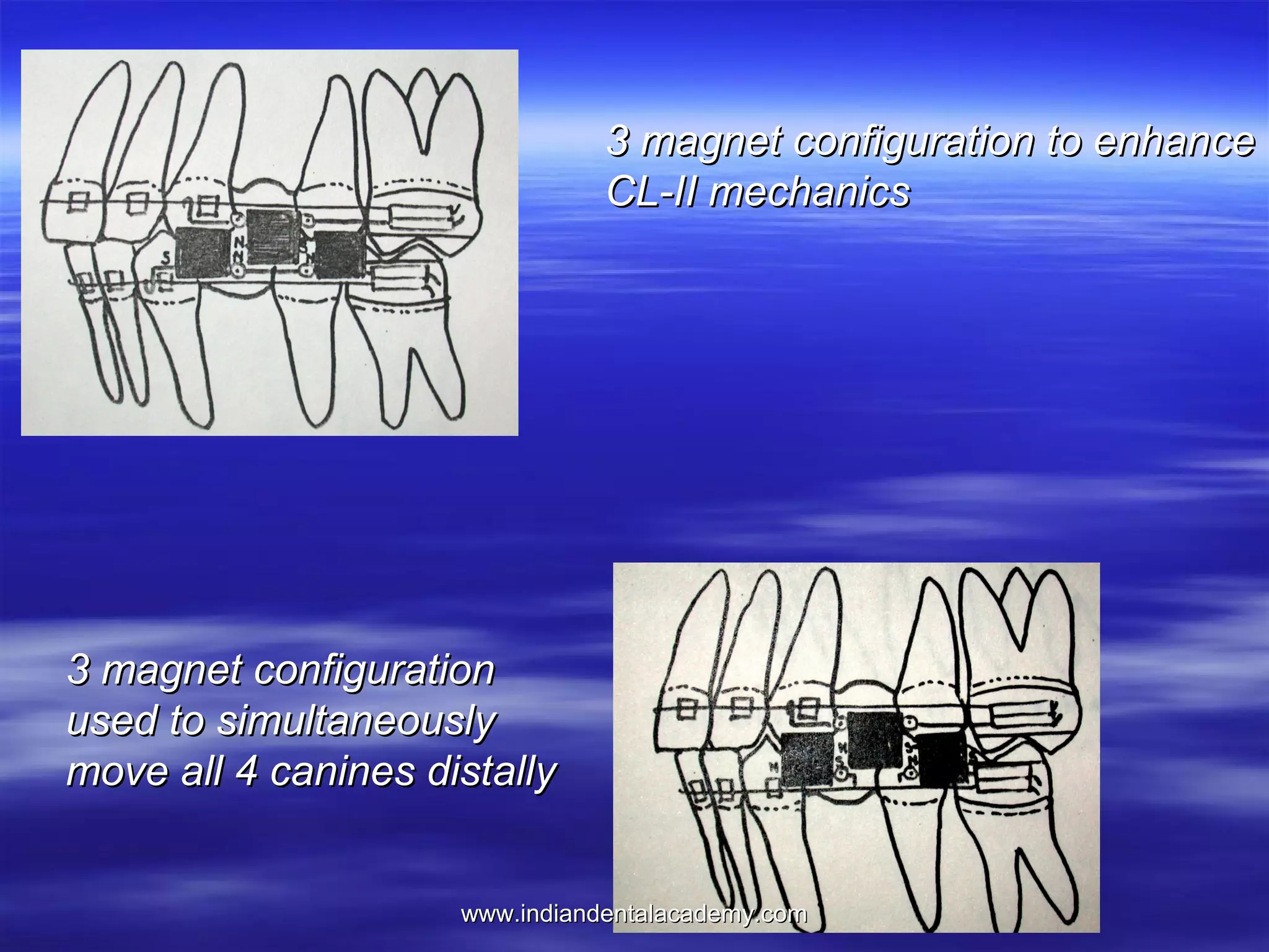 3 magnet configuration to enhance
CL-II mechanics

3 magnet configuration
used to simultaneously
move all 4 canines distally
www.indiandentalacademy.com

 