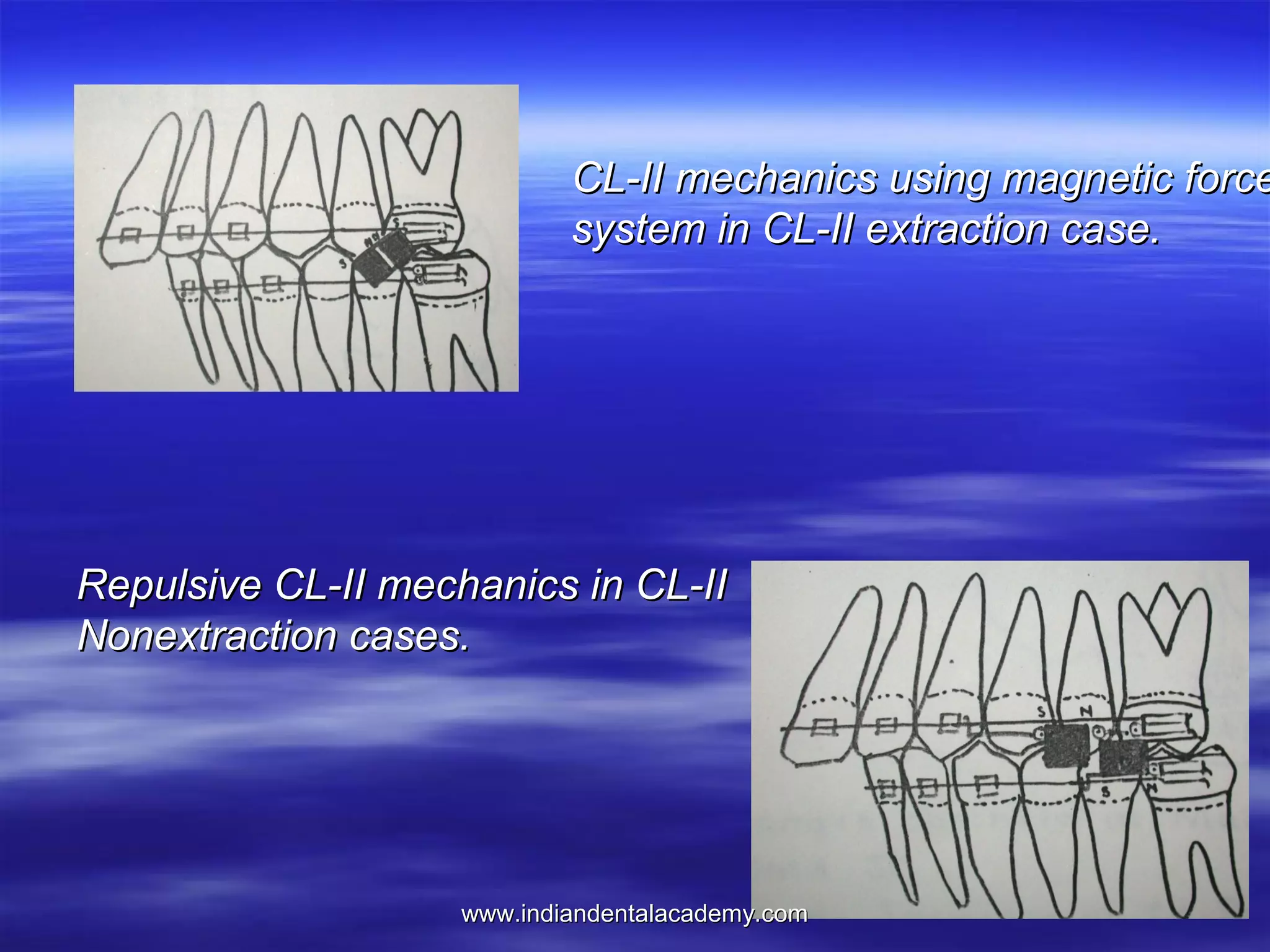 CL-II mechanics using magnetic force
system in CL-II extraction case.

Repulsive CL-II mechanics in CL-II
Nonextraction cases.

www.indiandentalacademy.com

 