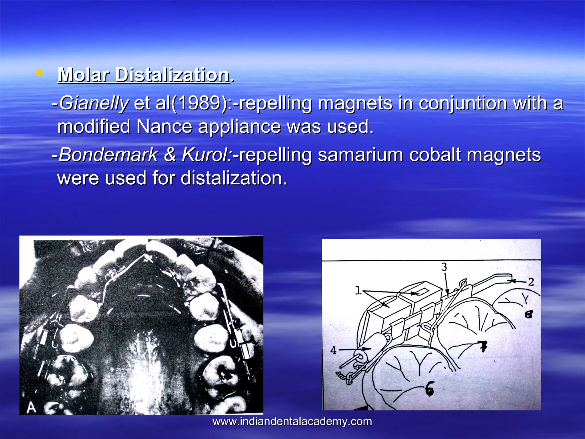  Molar Distalization.
-Gianelly et al(1989):-repelling magnets in conjuntion with a
modified Nance appliance was used.
-Bondemark & Kurol:-repelling samarium cobalt magnets
were used for distalization.

www.indiandentalacademy.com

 