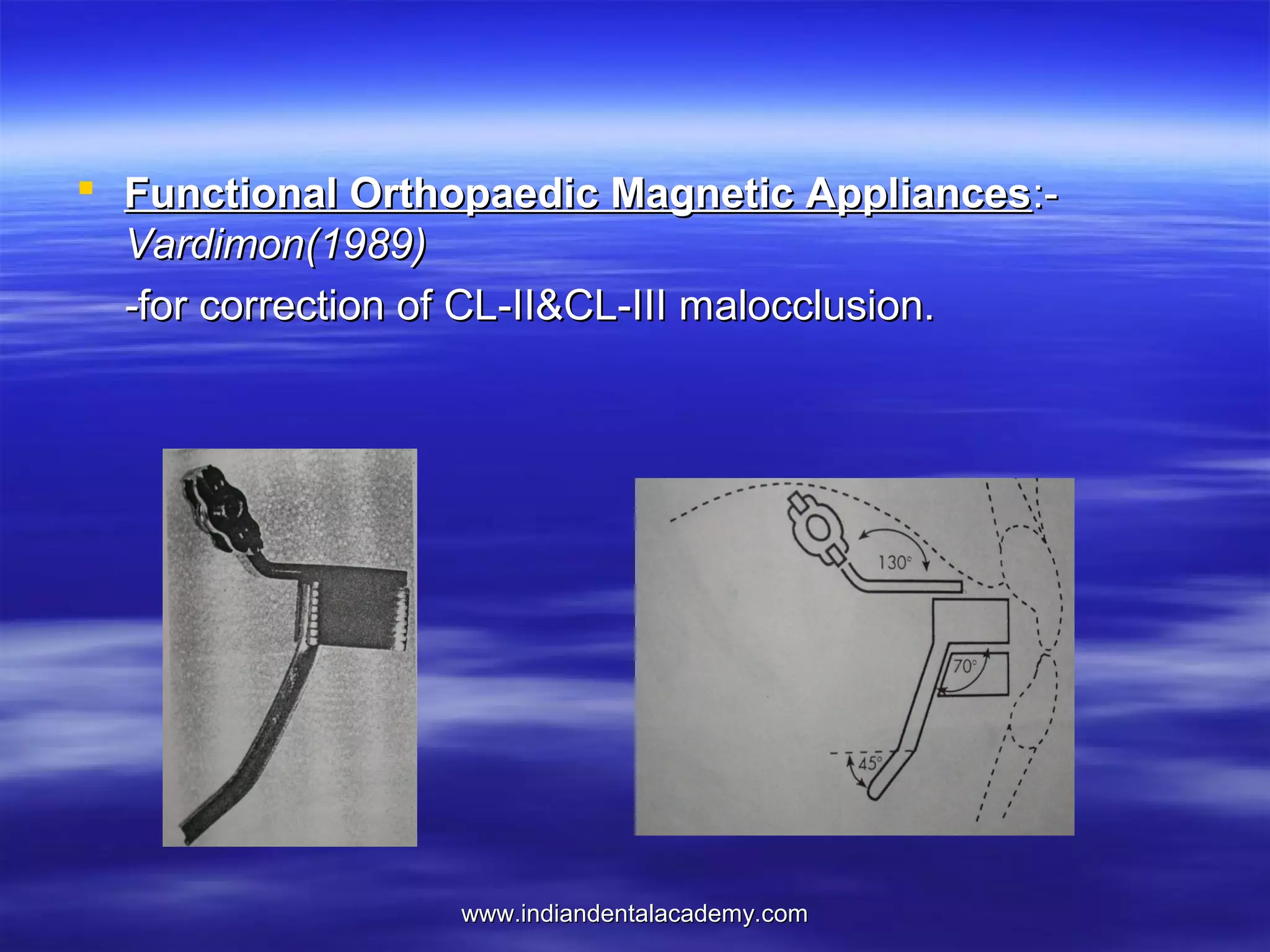  Functional Orthopaedic Magnetic Appliances:Vardimon(1989)
-for correction of CL-II&CL-III malocclusion.

www.indiandentalacademy.com

 