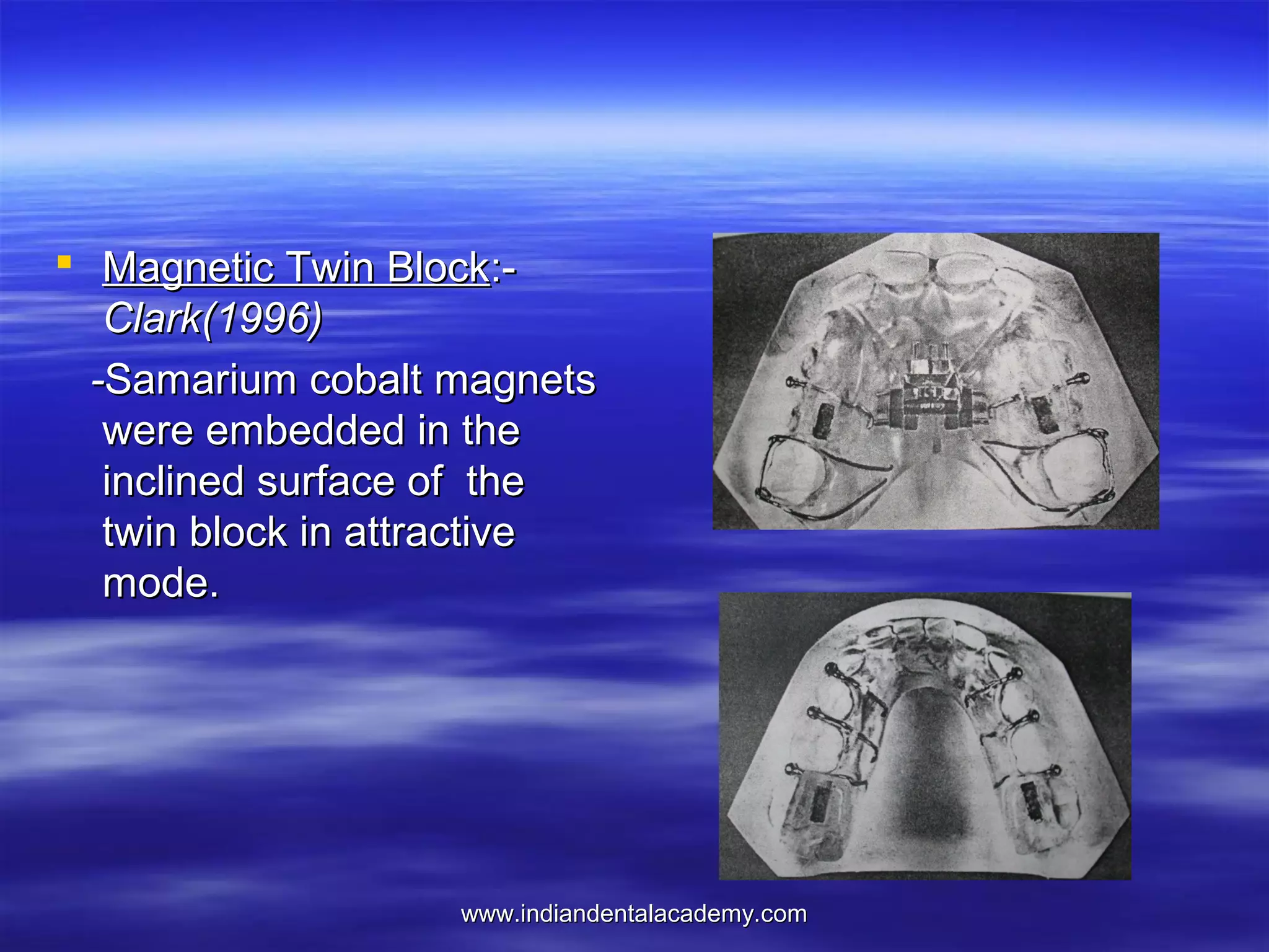 Magnetic Twin Block:Clark(1996)
-Samarium cobalt magnets
were embedded in the
inclined surface of the
twin block in attractive
mode.

www.indiandentalacademy.com

 