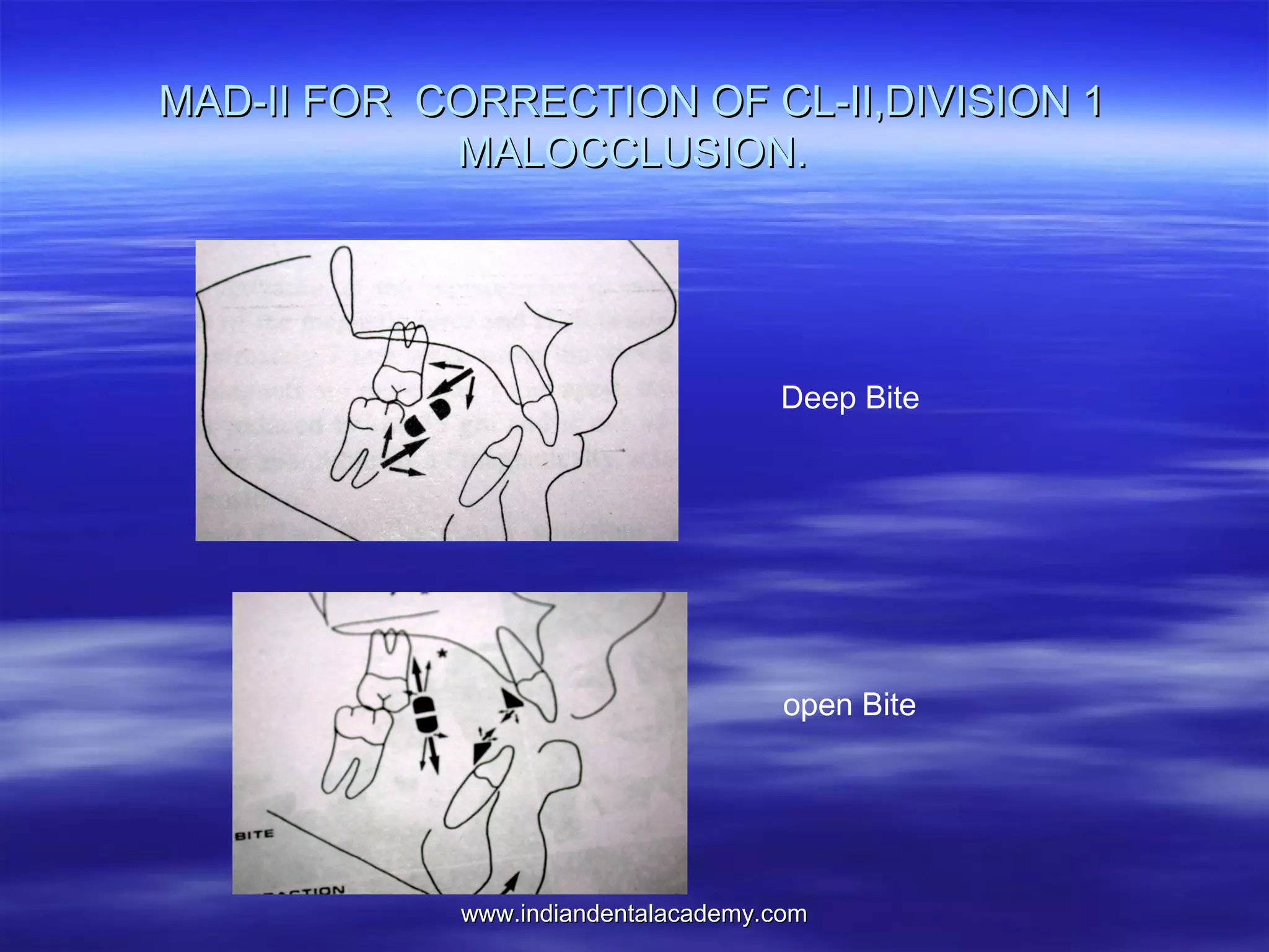 MAD-II FOR CORRECTION OF CL-II,DIVISION 1
MALOCCLUSION.

Deep Bite

open Bite

www.indiandentalacademy.com

 