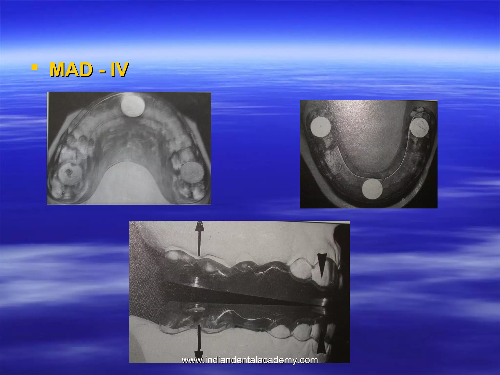  MAD - IV

www.indiandentalacademy.com

 