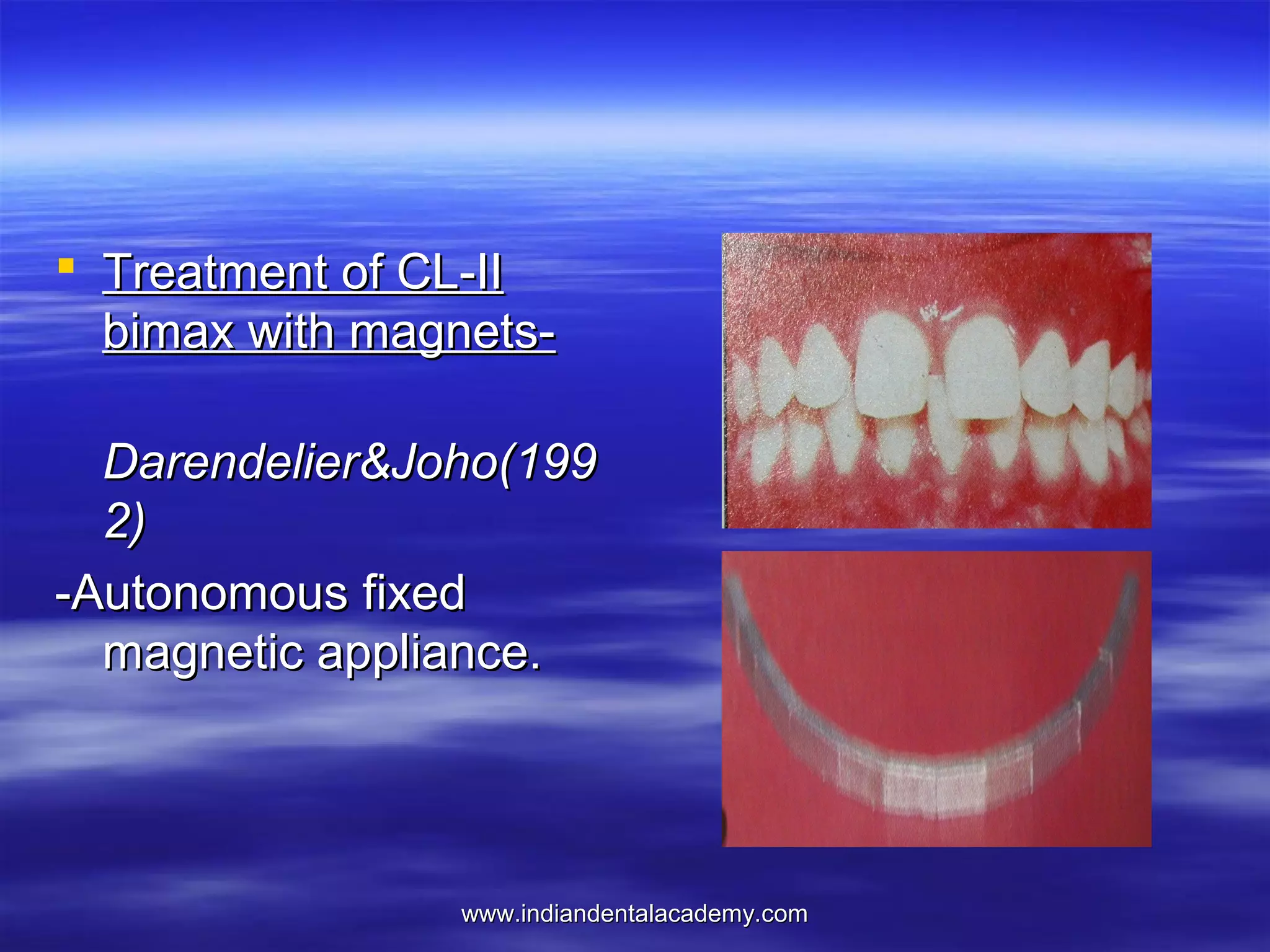  Treatment of CL-II
bimax with magnetsDarendelier&Joho(199
2)
-Autonomous fixed
magnetic appliance.

www.indiandentalacademy.com

 