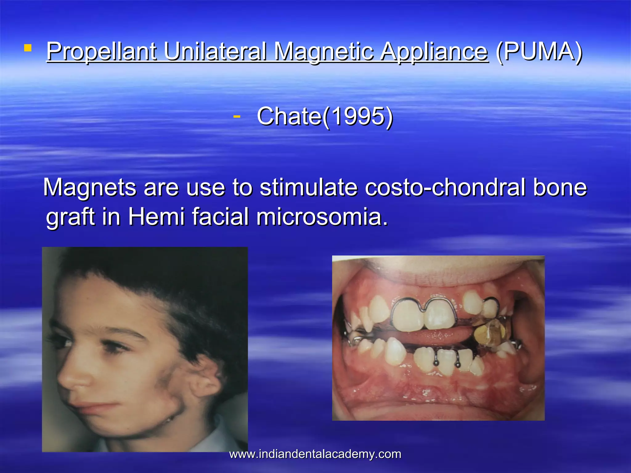 Propellant Unilateral Magnetic Appliance (PUMA)
- Chate(1995)
Magnets are use to stimulate costo-chondral bone
graft in Hemi facial microsomia.

www.indiandentalacademy.com

 
