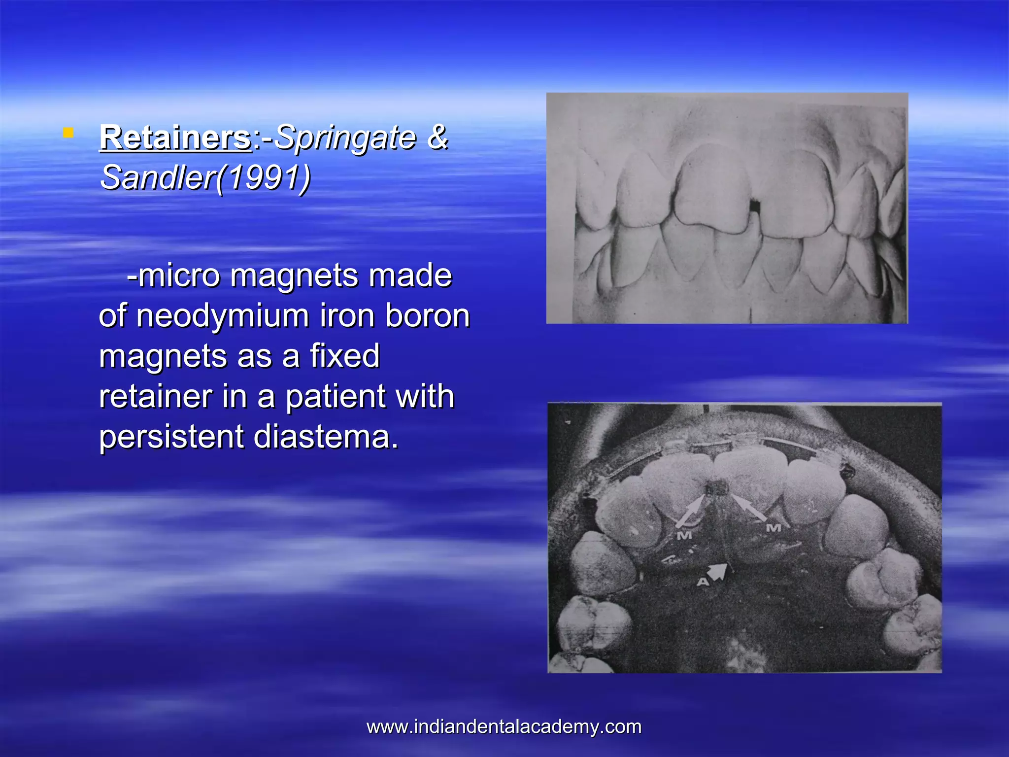  Retainers:-Springate &
Sandler(1991)
-micro magnets made
of neodymium iron boron
magnets as a fixed
retainer in a patient with
persistent diastema.

www.indiandentalacademy.com

 