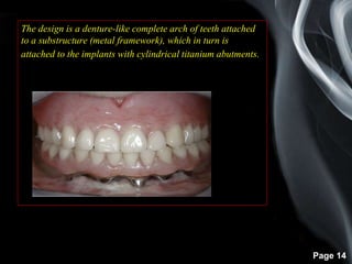 Page 14
The design is a denture-like complete arch of teeth attached
to a substructure (metal framework), which in turn is
attached to the implants with cylindrical titanium abutments.
 