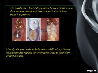 Page 15
The prosthesis is fabricated without flange extensions and
does not rely on any soft tissue support. It is entirely
implant supported
Usually, the prosthesis includes bilateral distal cantilevers,
which extend to replace posterior teeth (back to premolars
or first molars).
 