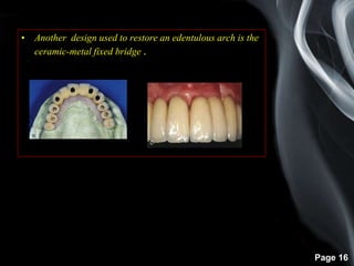 Page 16
• Another design used to restore an edentulous arch is the
ceramic-metal fixed bridge .
 