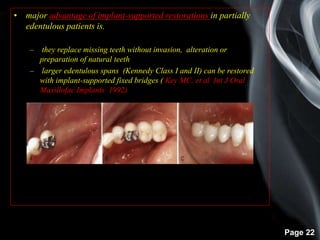 Page 22
• major advantage of implant-supported restorations in partially
edentulous patients is.
– they replace missing teeth without invasion, alteration or
preparation of natural teeth
– larger edentulous spans (Kennedy Class I and II) can be restored
with implant-supported fixed bridges ( Key MC, et al Int J Oral
Maxillofac Implants 1992)
 